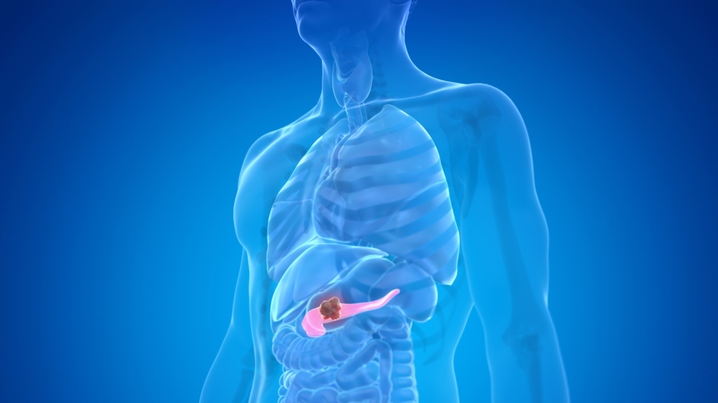 Nueva vía contra el cáncer de páncreas: una investigación española abre una prometedora estrategia terapéutica